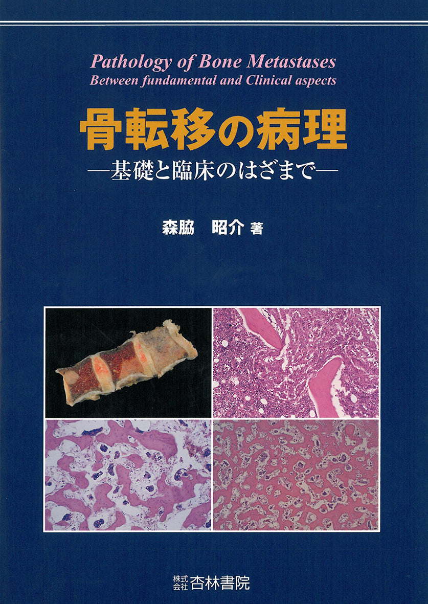 骨転移の病理